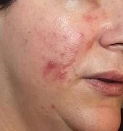 Vorher: Wange mit Rötungen
